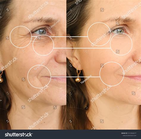 Woman Face Wrinkles Before After Treatment Stock Photo 1913928277