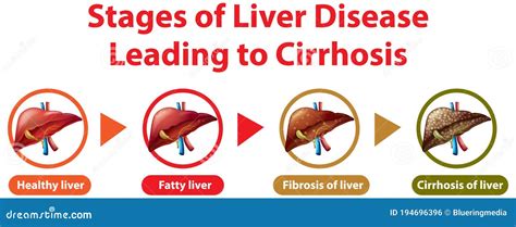 Stages Of Liver Disease Leading To Cirrhosis Stock Vector Free Download Nude Photo Gallery