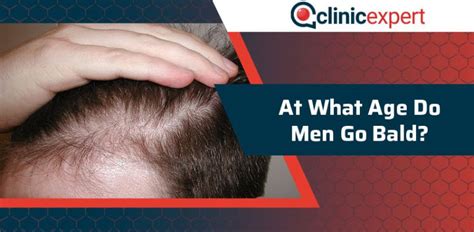 At What Age Do Men Go Bald Clinicexpert Healthcare