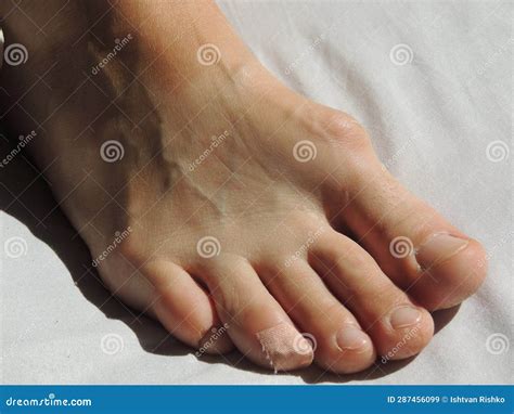 Painful Gout On The Foot Of A Middle Aged Woman Stock Image Image Of Cure Human 287456099