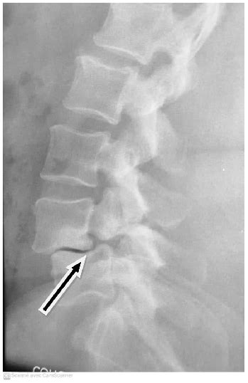 Lateral Radiography Of Lumbar Spine Showing Grade I Spondylolisthesis