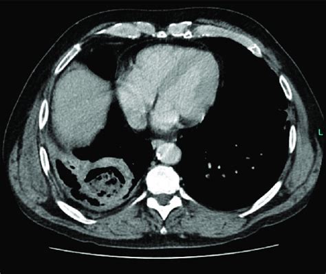 Image Of The Preoperative Ct Scan Showing The Suspect Lung Abscess
