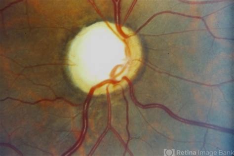 Glaucomatous Optic Atrophy Goa Retina Image Bank