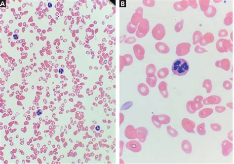 Megaloblastic Anemia Due To Severe Vitamin B12 Deficiency Cleveland