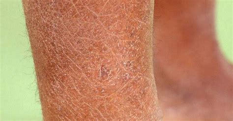Dry Skin Vücutta Nasıl Görünür Güncel Bilgiler 2023