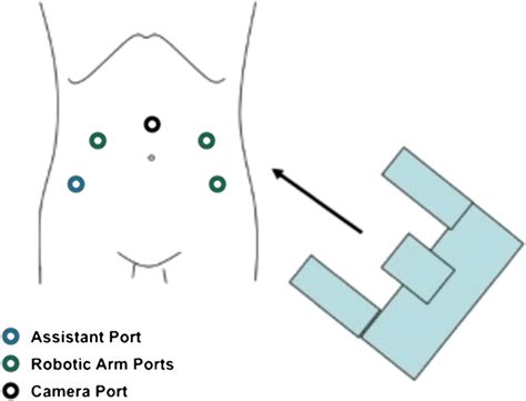 Trocar Placement For A Laparoscopic And Or Robotic Radical Trachelectomy Download Scientific