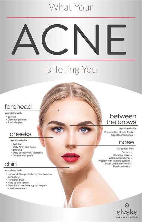 What Your Acne Is Telling You Face Skin Care Skin Care Acne Beauty