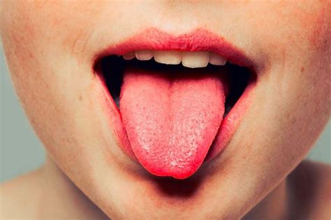 How To Get Rid Of Lie Bumps On Your Tongue 9 Natural Ways Lie