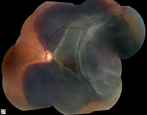 Massive Submacular Hemorrhage Retina Image Bank