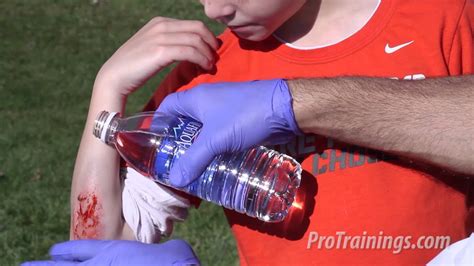 Capillary action is the movement of water within the spaces of a porous material due to the forces of adhesion, cohesion and surface tension. Capillary Bleeding (Child) - YouTube
