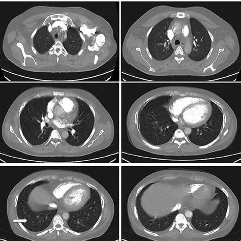 Contrast Enhanced Computed Tomography Of The Chest Showed Ground Glass