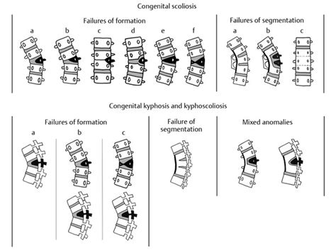 6 Congenital Deformities Of The Spine Musculoskeletal Key