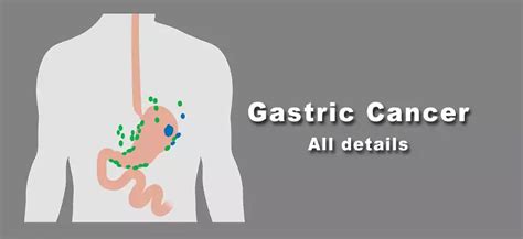 All About Gastric Cancer Causes Symptoms Diagnosis Treatment And