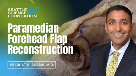 Paramedian Forehead Flap Reconstruction Prabhat K Bhama M D YouTube