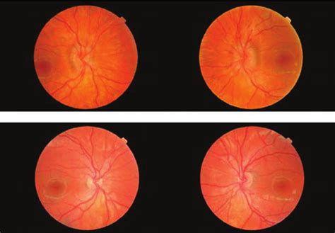 Bilateral Optic Disc Swelling Identifi Ed By Diabetic Retinopathy