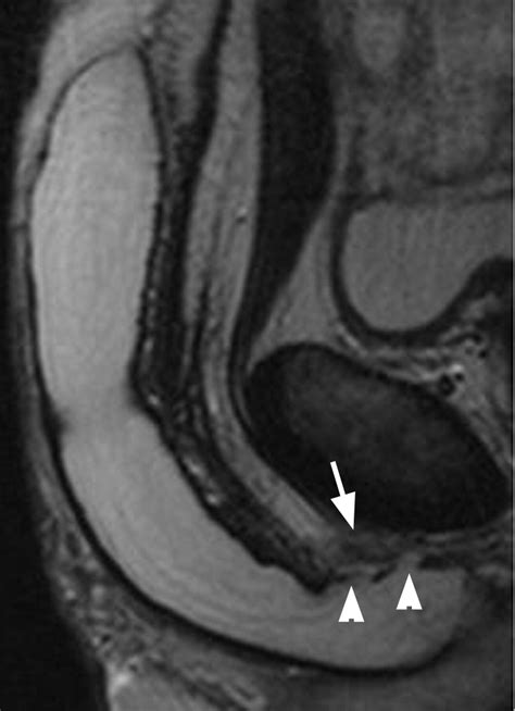 Mr Imaging Of Nonmalignant Penile Lesions Radiographics