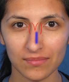 From tiger stripes to brownie batter face, you can find it all here. Rhinoplasty Correction - Crooked Nose Deformity