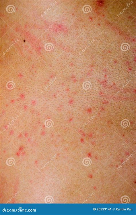 Dermatitis Rash Pictures Photos