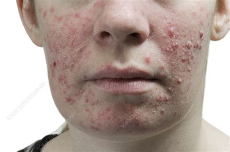 Acne Vulgaris On The Face Stock Image C0166972 Science Photo Library