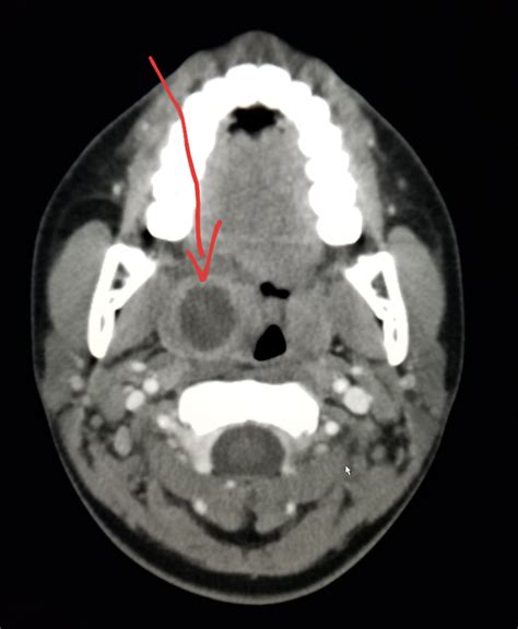 Neck CT Tonsillitis With An Abscess In Patient With Sore Throat And Neck Pain Radiologist
