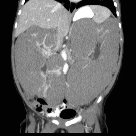 Coronal Slice Of Ct Abdomenpelvis With Iv And Oral Contrast Showing