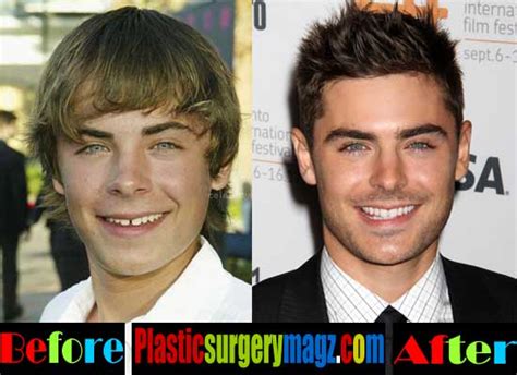 Heartthrob zac efron is one of the male stars who is being rumored of undergoing plastic surgery to look better. Zac Efron Nose Job Before and After Pictures | Plastic Surgery Magazine