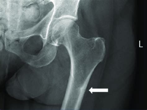 Ap X Ray Of Left Femur Lateral Proximal Femoral Cortical Hypertrophy