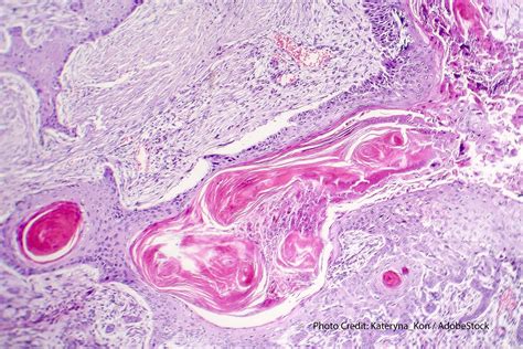 Squamous Cell Lung Cancer Treatment