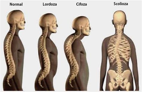 Cifoza Lordoza și Scolioza Ce Le Diferențiază și Ce Le Aseamănă