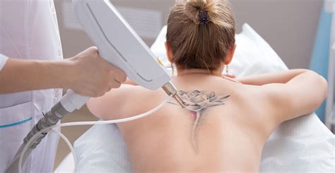 At the end of the day, an excellent pico laser that is suitable for asian skin is just a tool for the doctor. Laser Tattoo Removal Pensacola | Tattoo Removal Pensacola