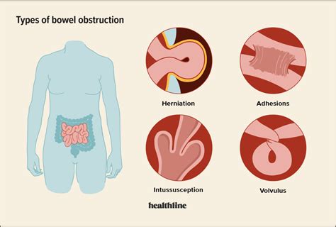 Female Bowel Obstruction Symptoms And Treatment Options
