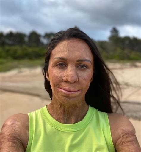 Turia Pitt Breaks Down Beauty Standards With Groundbreaking Campaign Now To Love