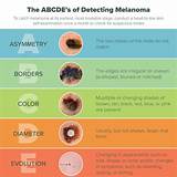 The doctor may suggest other tests that will help make a diagnosis and determine the overall stage of. Dangers of Melanoma - Skin Cancer Awareness Month