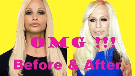 Donatella Versace Plastic Surgery Before And After Youtube