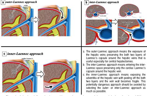 Figure 8 From Standardization Of Anatomic Liver Resection Based On