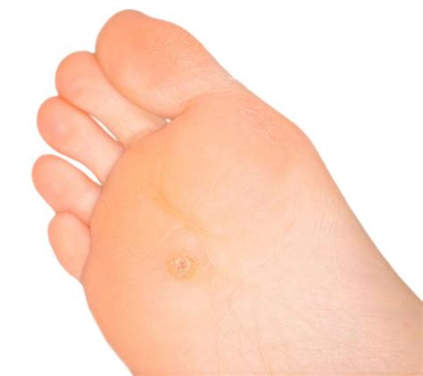 What Are The Different Types Of Callus Treatment