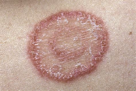 Types Of Fungal Skin Infections And Treatment Options