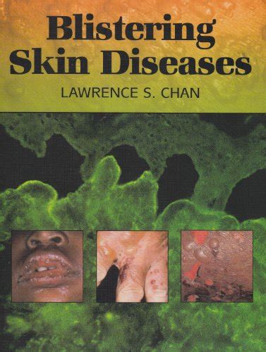 Blistering Skin Diseases Chan Lawrence S 9781555815202 Abebooks