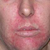 Images of Best Makeup For Perioral Dermatitis