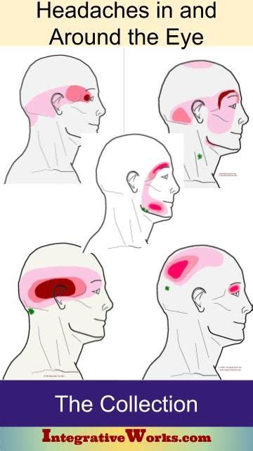 Eye Trigger Point Pain