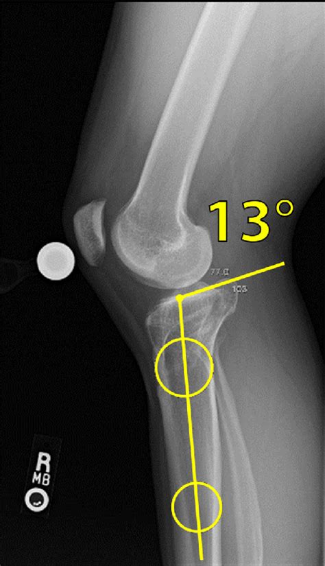 Lateral View Radiograph Of A Right Knee With The Patient Standing
