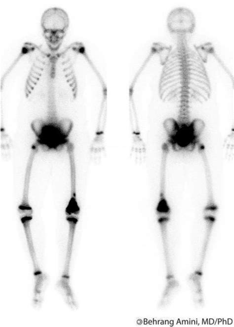 Roentgen Ray Reader Multifocal Osteosarcoma