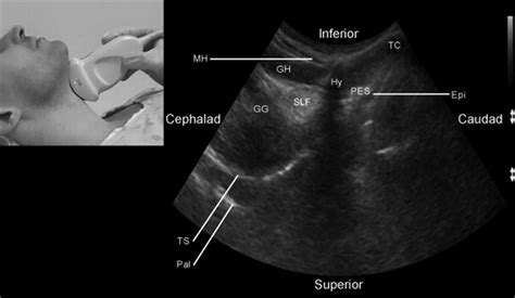 Use Of Sonography For Airway Assessment Singh 2010 Journal Of
