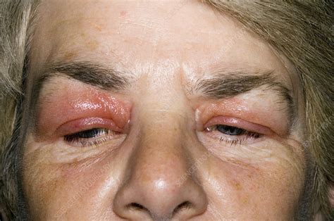 Swollen Eyelids Stock Image M320 0445 Science Photo Library