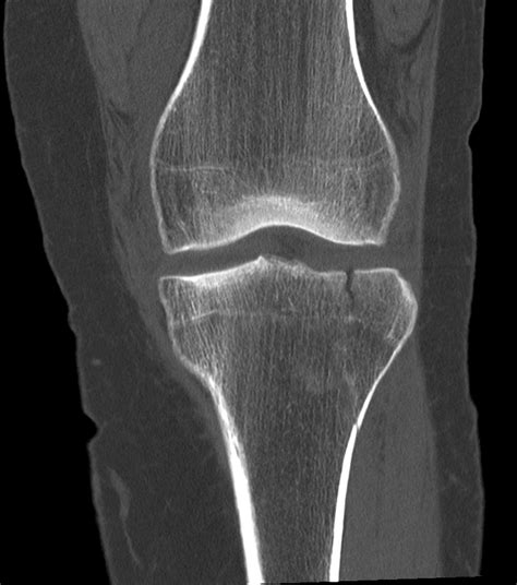 Lateral Tibial Plateau Fracture With Lipohemarthrosis Image