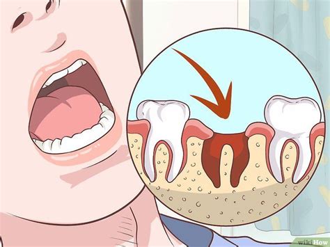 How To Heal Gums After A Tooth Extraction With Pictures Rough Wisdom