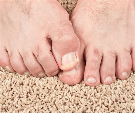 Treatment For Itchy Feet In North Seattle Foot And Ankle Center Of