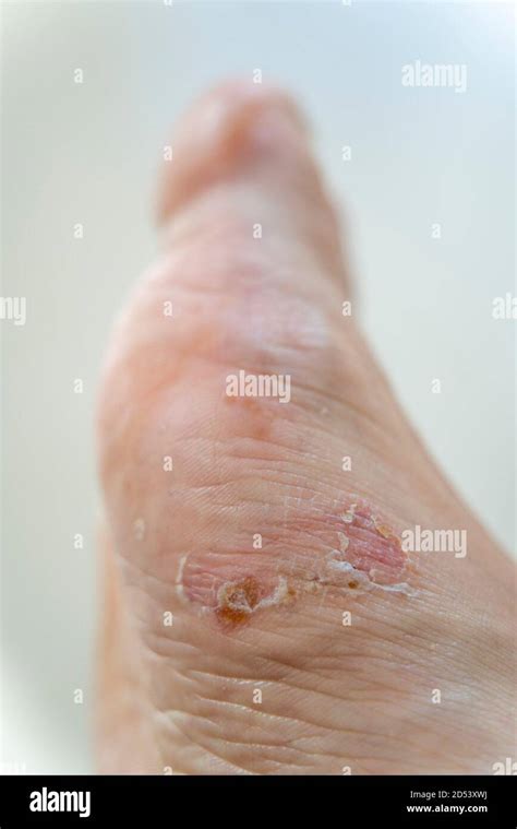 Erythema High Resolution Stock Photography And Images Alamy