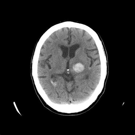 The basal ganglia are best known for their role in controlling movement. Hypertensive basal ganglia haemorrhage | Radiology Case ...