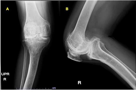 Figure 1 From Total Knee Arthroplasty Following Application Of Taylor